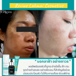 รีวิว เซรั่มสลายฝ้า