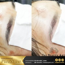 LASER TATTOO REMOVAL 
