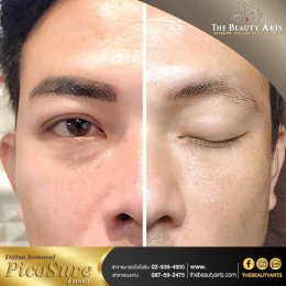 LASER TATTOO REMOVAL 
