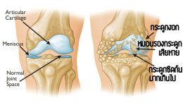 ข้อเข่าเสื่อม