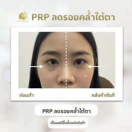 PRP ลดรอยคล้ำใต้ตา