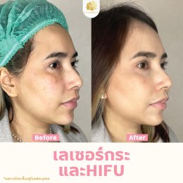 รีวิว HIFU 