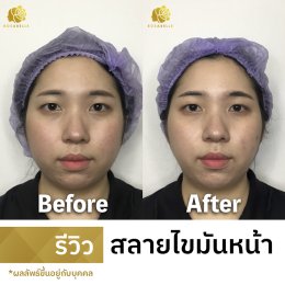 รีวิวสลายไขมัน