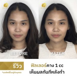 รีวิวฟิลเลอร์เติมเต็ม