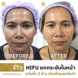 รีวิว HIFU 