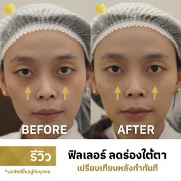 รีวิวฟิลเลอร์เติมเต็ม