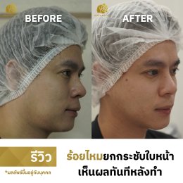 ร้อยไหม ยกกระชับใบหน้าโดยไม่ต้องผ่าตัด