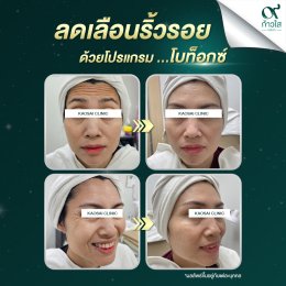  รีวิวผลลัพธ์ หลังฉีด Botox 