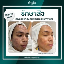 รักษาสิว Acne Scar Laser