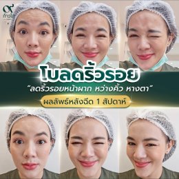  รีวิวผลลัพธ์ หลังฉีด Botox 