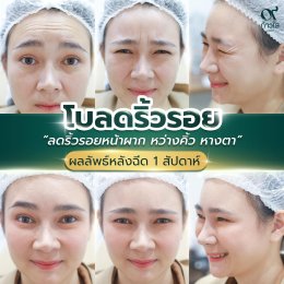  รีวิวผลลัพธ์ หลังฉีด Botox 