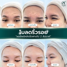  รีวิวผลลัพธ์ หลังฉีด Botox 