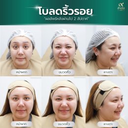  รีวิวผลลัพธ์ หลังฉีด Botox 