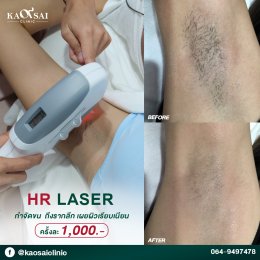 Laser กำจัดขน 