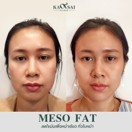 Meso Fat ลดแก้ม ลดเหนียง 