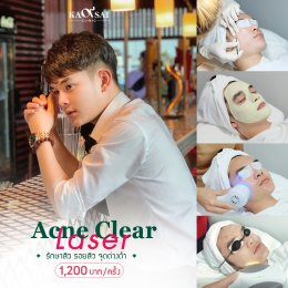 Acne Scar Laser