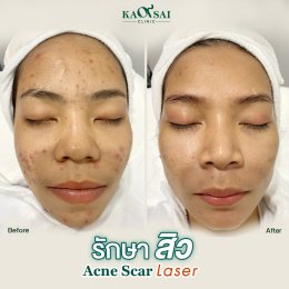 รักษาสิว Acne Scar Laser