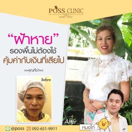 ร้อยไหมรักษาฝ้า+หน้าเด็ก 
