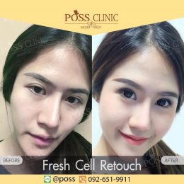 Fresh Cell หน้าเด็ก