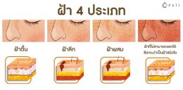 ฝ้ามีกี่ชนิด Melasma Type?