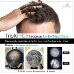 Triple Hair 3H Plus ดูแลผมร่วงผมบาง ครบด้วย เลเซอร์ l สะกิดตัวยา | ผลักวิตามิน | ฉายแสง