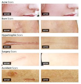 ดูแลแผลเป็นนูน คีลอยด์ ด้วยเทคนิค Triple Laser Therapy: Picosecond Laser + Gold Toning + Fractional Laser + ฉีดยา Intralesional Injection