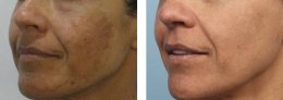 PicoLaser Melasma Treatment Program โปรแกรมดูแลฝ้าครบวงจร 