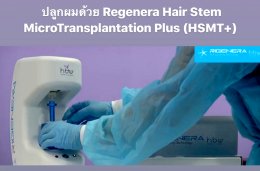 ปลูกผมด้วยเทคนิคพิเศษล่าสุด Regenera Hair Stem MicroTransplantation Plus (HSMT+)