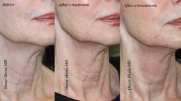 INFINI Microneedling RF กระตุ้นการสร้างคอลลาเจน กระชับผิว ดูแลหลุมสิว แผลเป็น พิเศษช่วงแนะนำ ดูแลทั่วไปหน้า 5 ครั้ง 39,500 บ. (จากปกติ 75,000 บ.) ***จำนวนจำกัดเพียง 10 สิทธิ์ เท่านั้น***