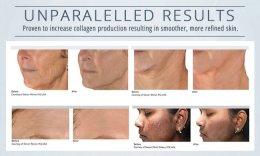 INFINI Microneedling RF กระตุ้นการสร้างคอลลาเจน กระชับผิว ดูแลหลุมสิว แผลเป็น พิเศษช่วงแนะนำ ดูแลทั่วไปหน้า 5 ครั้ง 39,500 บ. (จากปกติ 75,000 บ.) ***จำนวนจำกัดเพียง 10 สิทธิ์ เท่านั้น***