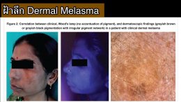 ฝ้ามีกี่ชนิด Melasma Type?