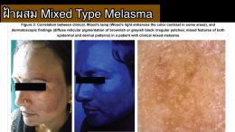 ฝ้ามีกี่ชนิด Melasma Type?