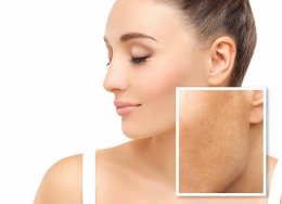 PicoLaser Melasma Treatment Program โปรแกรมดูแลฝ้าครบวงจร 