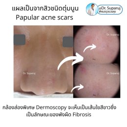 แผลเป็นจากสิวที่จมูก ดูแลได้อย่างไร Acne Scar on Nose ?