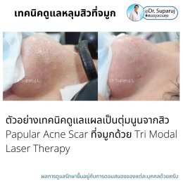 แผลเป็นจากสิวที่จมูก ดูแลได้อย่างไร Acne Scar on Nose ?