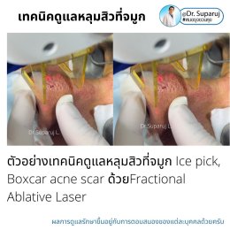 แผลเป็นจากสิวที่จมูก ดูแลได้อย่างไร Acne Scar on Nose ?