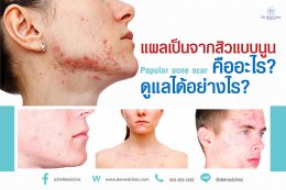 แผลเป็นจากสิวแบบนูน Papular acne scar คืออะไร ?ดูแลได้อย่างไร ?