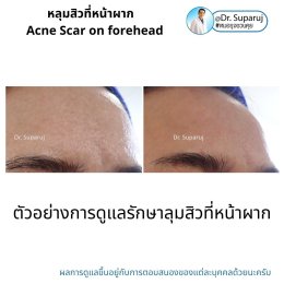 หลุมสิวที่หน้าผาก Acne Scar on forehead มีเทคนิคดูแลต่างจากบริเวณอื่นอย่างไร?