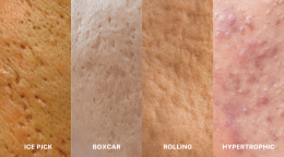 รักษาหลุมสิวด้วยการผ่าตัด Acne Scar Revision ด้วยเทคนิคผ่าตัดออก Punch Excision