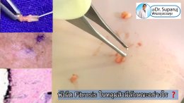 พังผืด Fibrosis ในหลุมสิวมีลักษณะอย่างไร ?
