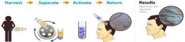 ดูแลผมร่วง ผมบางด้วย Regenera Hair Stem Cell Therapy !!