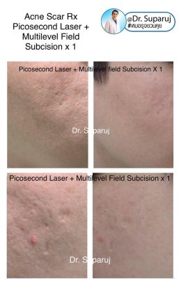 หลุมสิวแบบปากแคบ Icepick acne scar