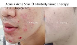 หลุมสิวแบบปากแคบ Icepick acne scar