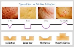 เทคนิคการดูแลหลุมสิวแบบกล่อง Boxcar scar
