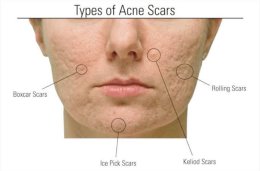 เทคนิคการดูแลหลุมสิวแบบกล่อง Boxcar scar