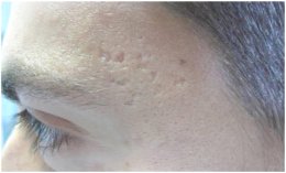 เทคนิคการดูแลหลุมสิวแบบกล่อง Boxcar scar
