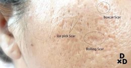 เทคนิคการดูแลหลุมสิวแบบกล่อง Boxcar scar