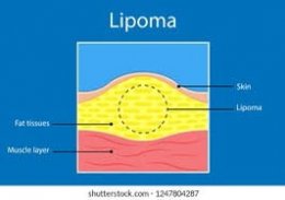 ก้อนเนื้อไขมัน หรือ เนื้องอกไขมัน (Lipoma) คืออะไร ดูแลได้อย่างไร ?
