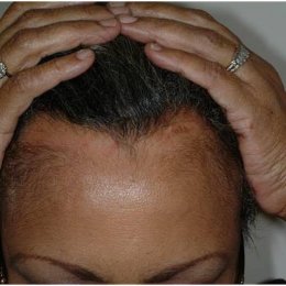 โรคผมร่วง Frontal fibrosing alopecia (FFA) คืออะไร ดูแลรักษาได้อย่างไร ?