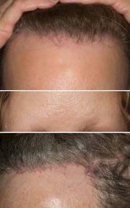 โรคผมร่วง Frontal fibrosing alopecia (FFA) คืออะไร ดูแลรักษาได้อย่างไร ?